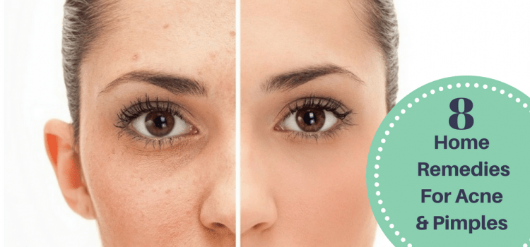 8 Home Remedies For Acne & Pimples